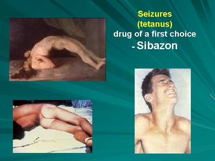 Seizures (tetanus) drug of a first choice - Sibazon 