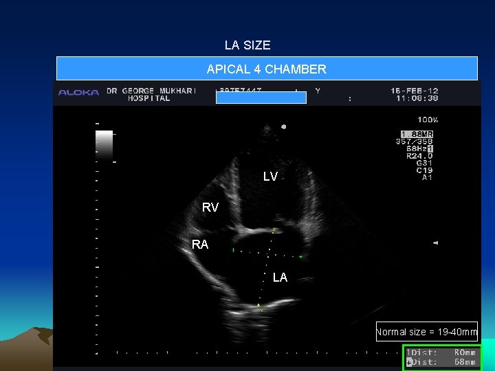 LA SIZE APICAL 4 CHAMBER LV RV RA LA Normal size = 19 -40