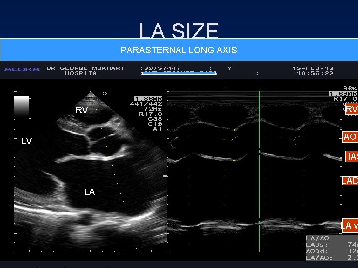 LA SIZE PARASTERNAL LONG AXIS RV RV AO LV IAS LAD LA LA w