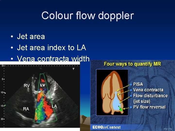 Colour flow doppler • Jet area index to LA • Vena contracta width RV