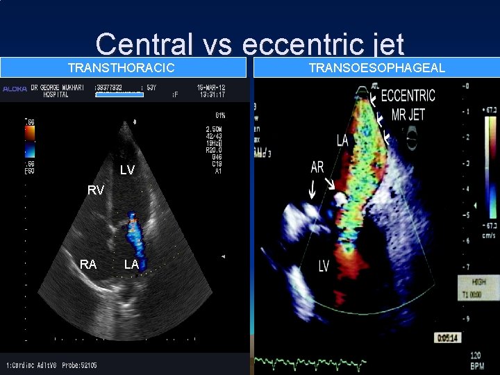 Central vs eccentric jet TRANSTHORACIC LV RV RA LA TRANSOESOPHAGEAL 