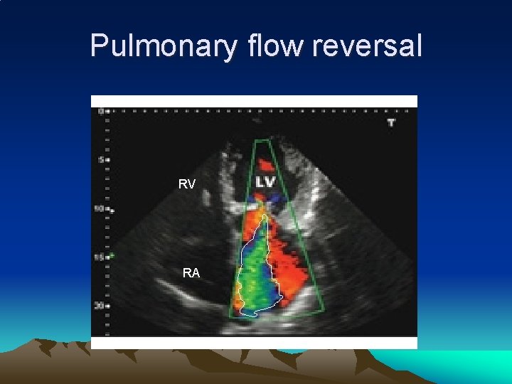 Pulmonary flow reversal RV RA 