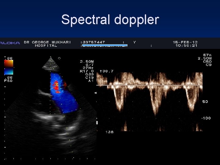 Spectral doppler 