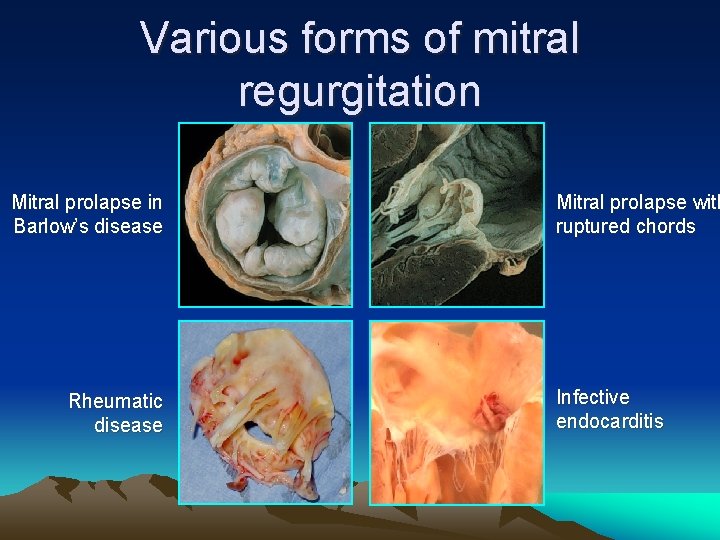 Various forms of mitral regurgitation Mitral prolapse in Barlow’s disease Rheumatic disease Mitral prolapse