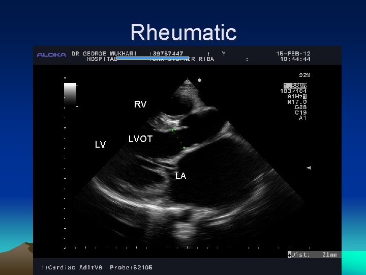 Rheumatic RV LV LVOT LA 