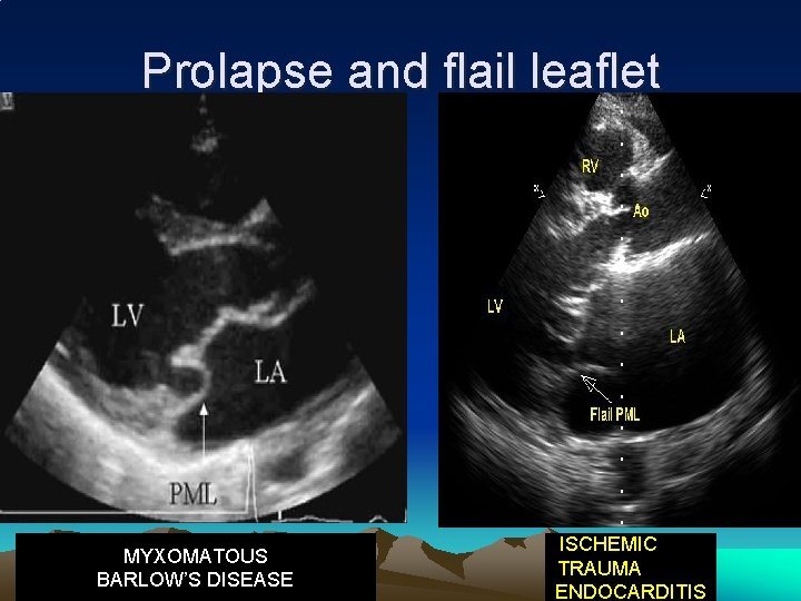 Prolapse and flail leaflet MYXOMATOUS BARLOW’S DISEASE ISCHEMIC TRAUMA ENDOCARDITIS 