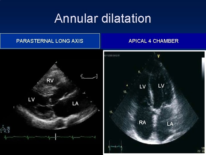 Annular dilatation PARASTERNAL LONG AXIS APICAL 4 CHAMBER RV LV LA RA LA 