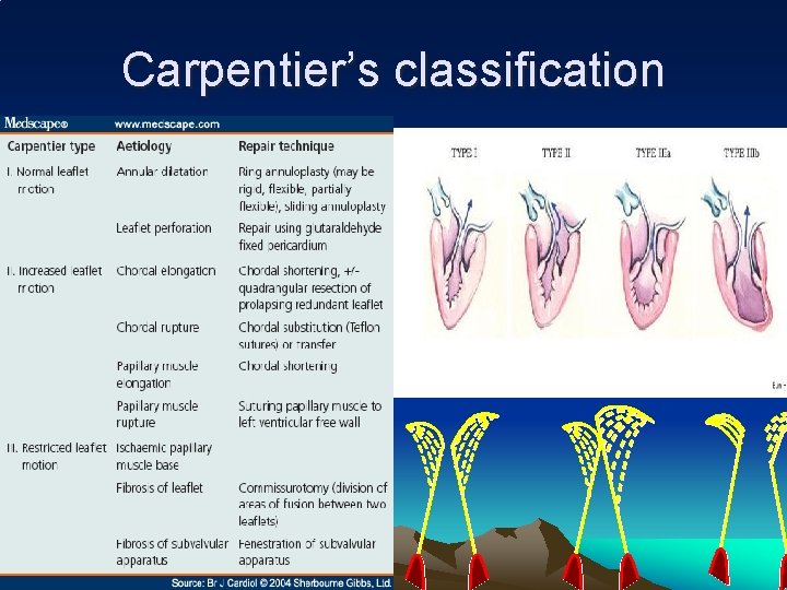 Carpentier’s classification 