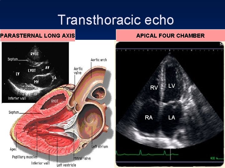 Transthoracic echo PARASTERNAL LONG AXIS APICAL FOUR CHAMBER RV RA LV LA 