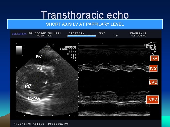 Transthoracic echo SHORT AXIS LV AT PAPPILARY LEVEL RV RV IVS PM LVPW AL