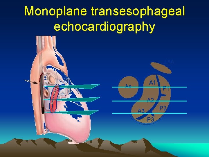 Monoplane transesophageal echocardiography LAA A 1 Ao P 1 A 2 P 2 A