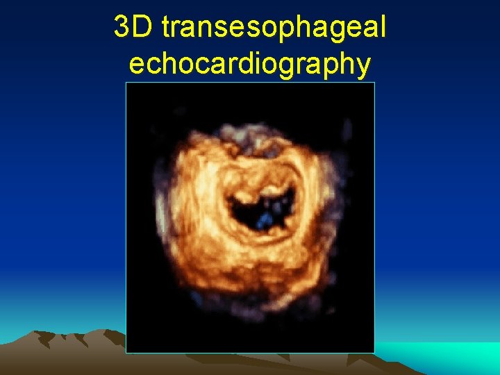 3 D transesophageal echocardiography 