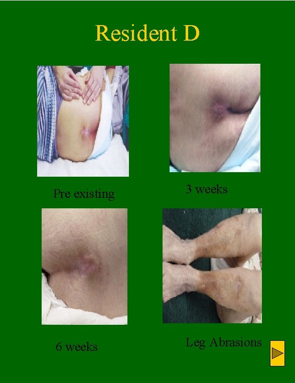 Resident D Pre existing 3 weeks 6 weeks Leg Abrasions 