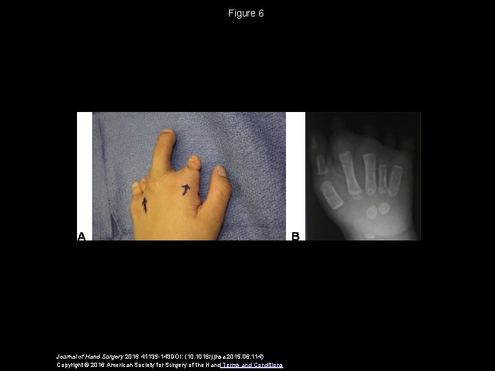 Figure 6 Journal of Hand Surgery 2016 41135 -143 DOI: (10. 1016/j. jhsa. 2015.