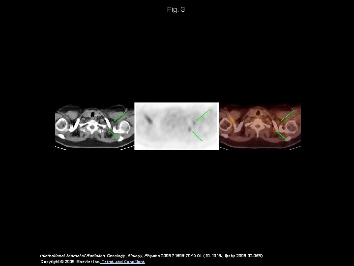 Fig. 3 International Journal of Radiation Oncology, Biology, Physics 2008 71695 -704 DOI: (10.