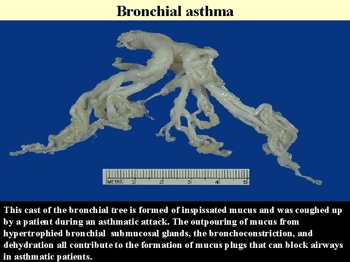 Bronchial asthma This cast of the bronchial tree is formed of inspissated mucus and