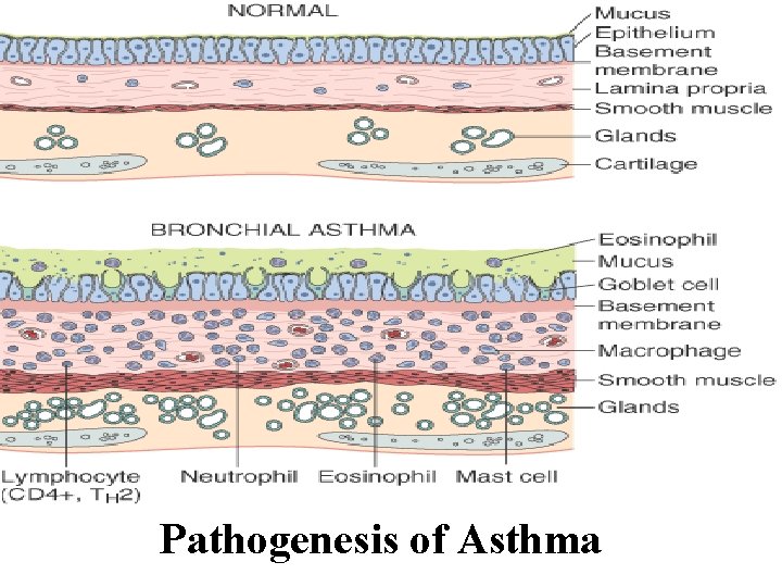 Pathogenesis of Asthma 