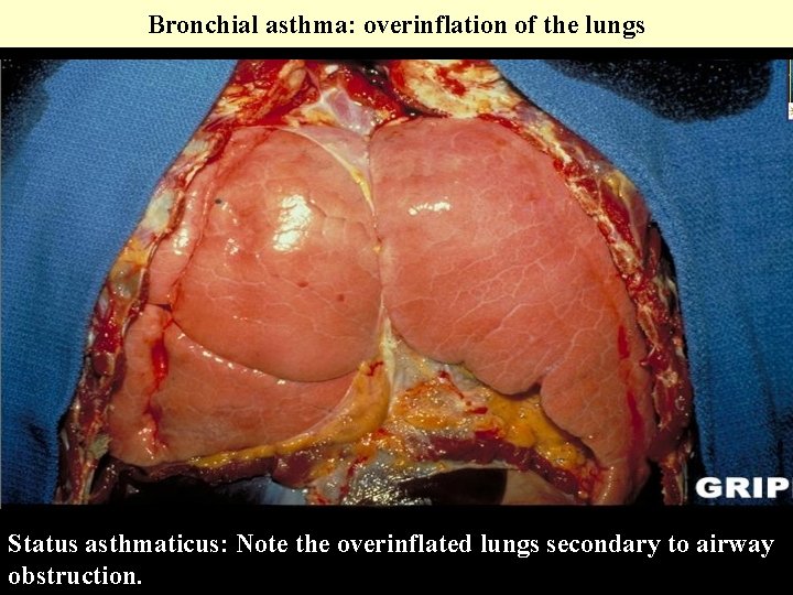 Bronchial asthma: overinflation of the lungs Status asthmaticus: Note the overinflated lungs secondary to