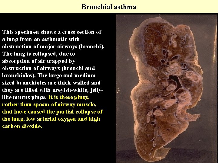 Bronchial asthma This specimen shows a cross section of a lung from an asthmatic