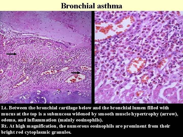 Bronchial asthma Lt. Between the bronchial cartilage below and the bronchial lumen filled with