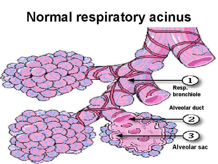 Normal respiratory acinus Resp. bronchiole Alveolar duct Alveolar sac 