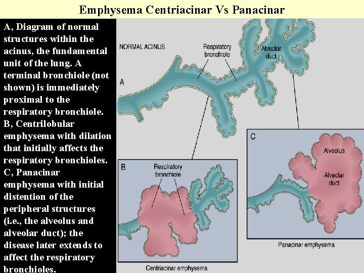 Emphysema Centriacinar Vs Panacinar A, Diagram of normal structures within the acinus, the fundamental