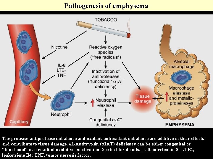 Pathogenesis of emphysema The protease-antiprotease imbalance and oxidant-antioxidant imbalance are additive in their effects