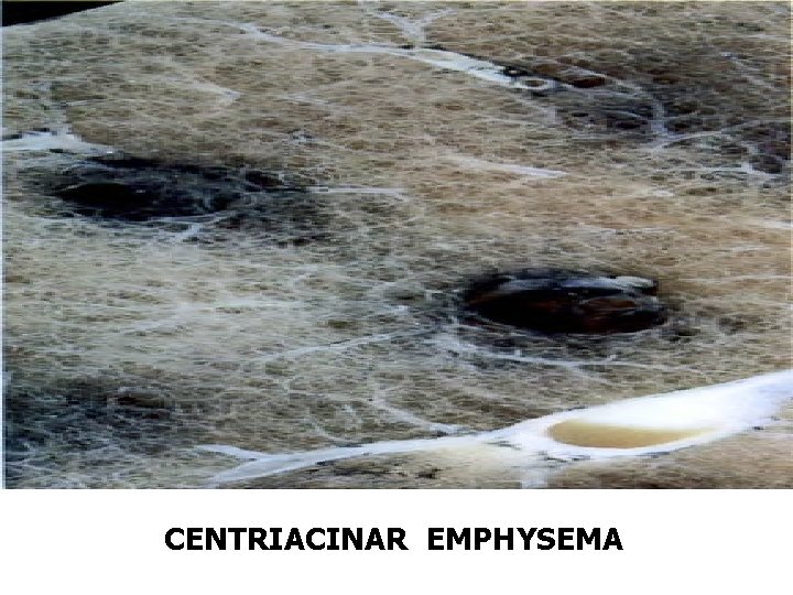 CENTRIACINAR EMPHYSEMA 