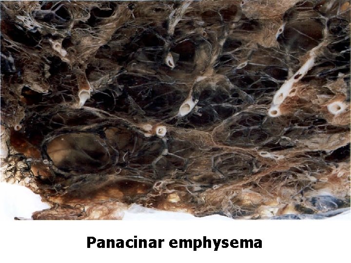 Panacinar emphysema 
