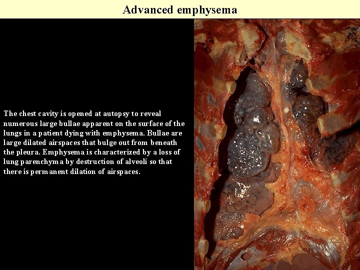 Advanced emphysema The chest cavity is opened at autopsy to reveal numerous large bullae