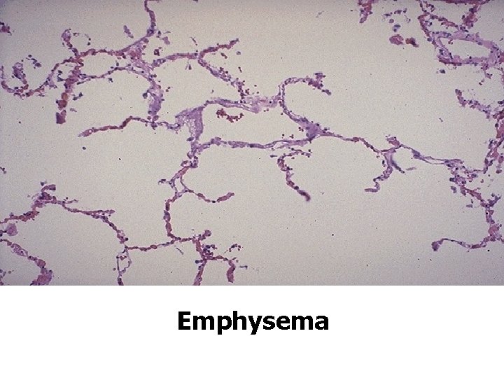 Emphysema 