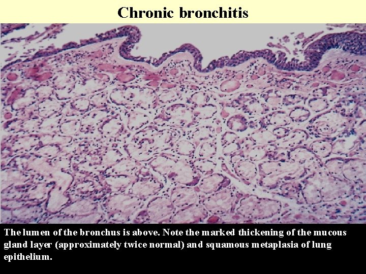 Chronic bronchitis The lumen of the bronchus is above. Note the marked thickening of