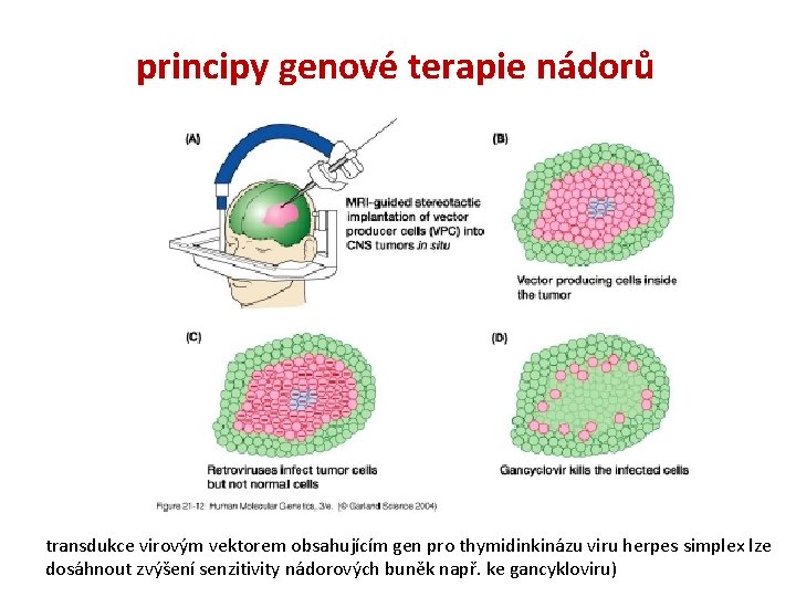 principy genové terapie nádorů transdukce virovým vektorem obsahujícím gen pro thymidinkinázu viru herpes simplex