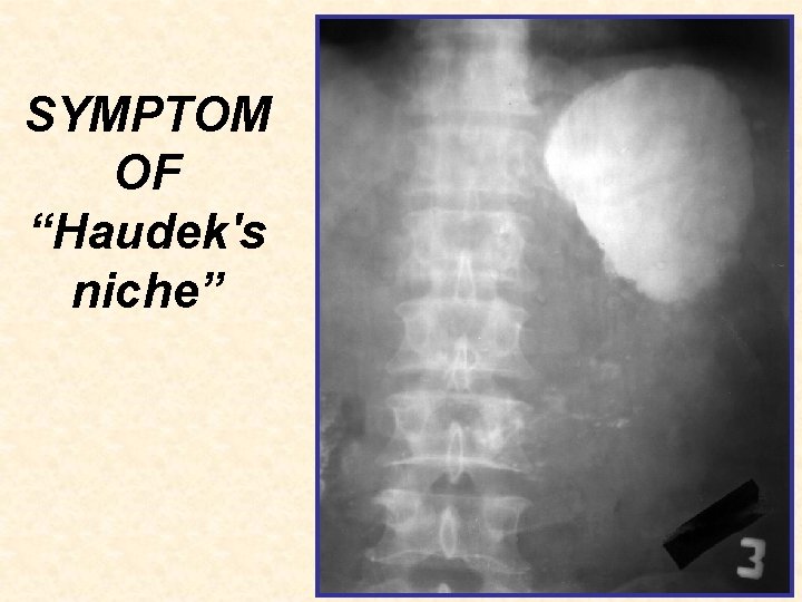 SYMPTOM OF “Haudek's niche” 
