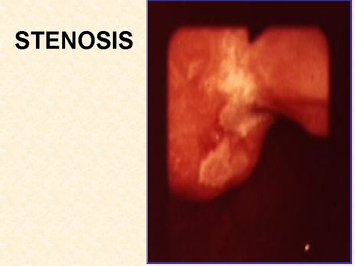 STENOSIS 