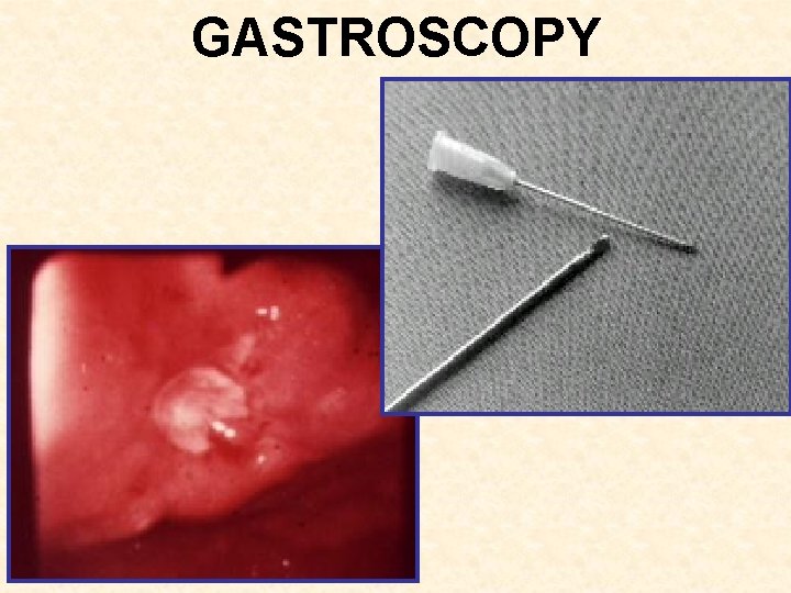 GASTROSCOPY 