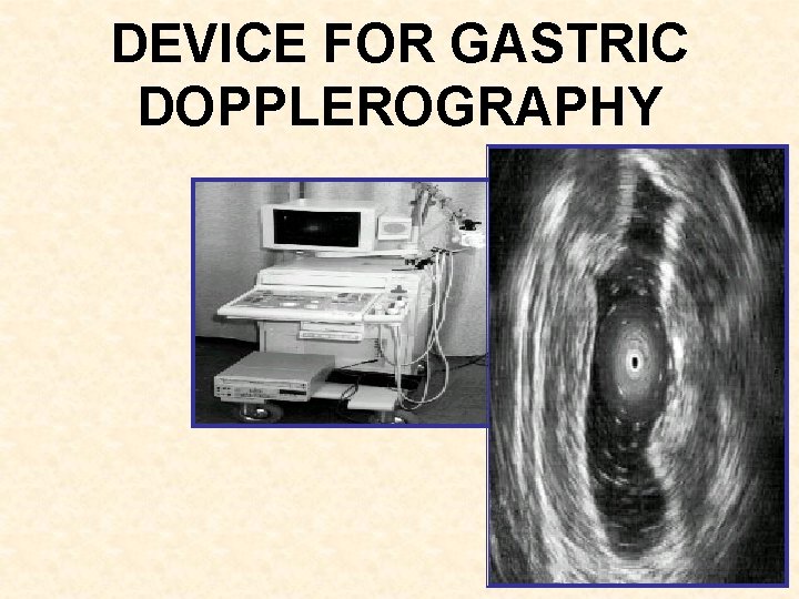DEVICE FOR GASTRIC DOPPLEROGRAPHY 