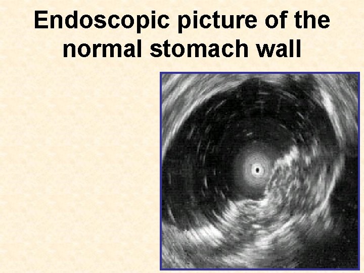 Endoscopic picture of the normal stomach wall 