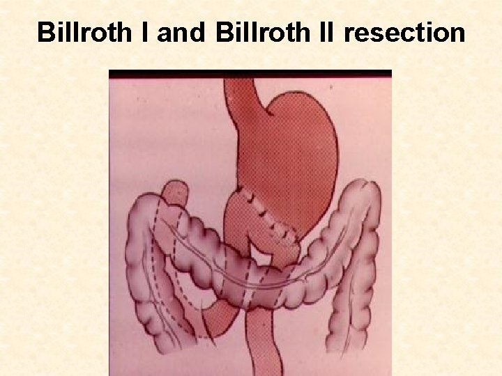 Billroth I and Billroth II resection 