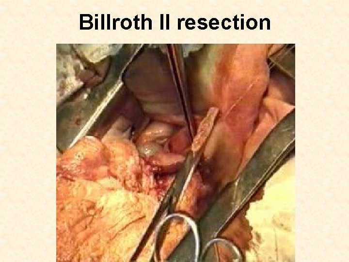 Billroth II resection 