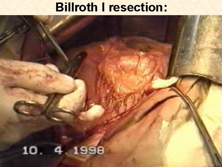 Billroth I resection: 