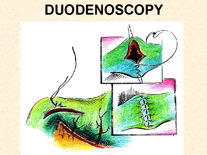 DUODENOSCOPY 