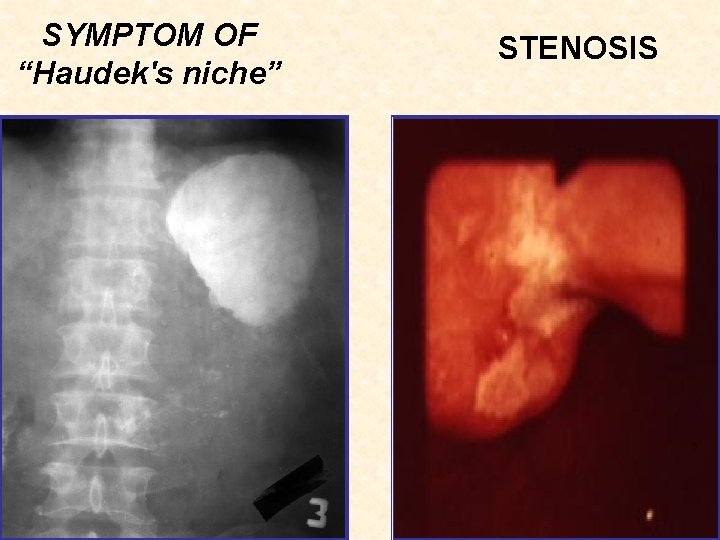 SYMPTOM OF “Haudek's niche” STENOSIS 
