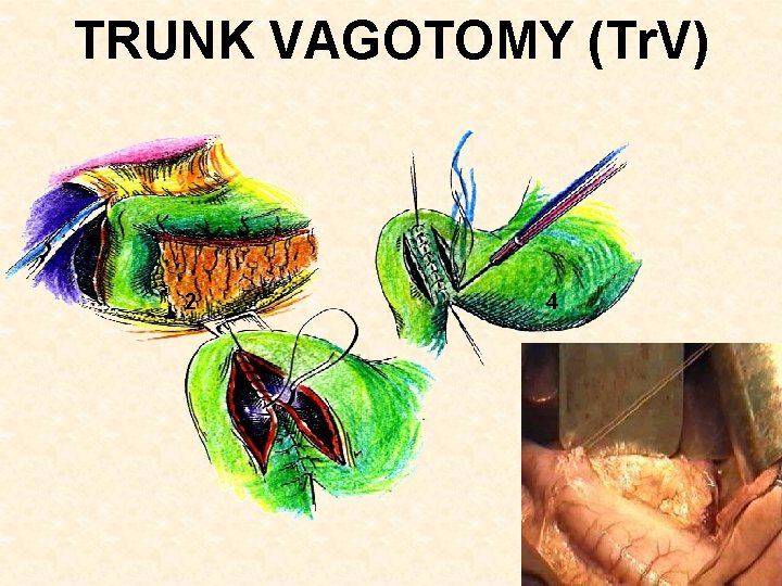 TRUNK VAGOTOMY (Tr. V) 2 4 
