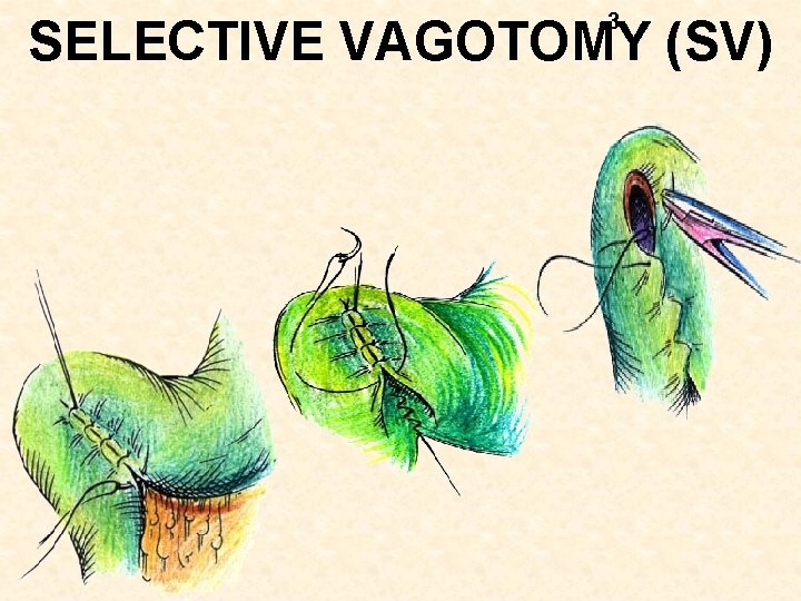 3 SELECTIVE VAGOTOMY (SV) 