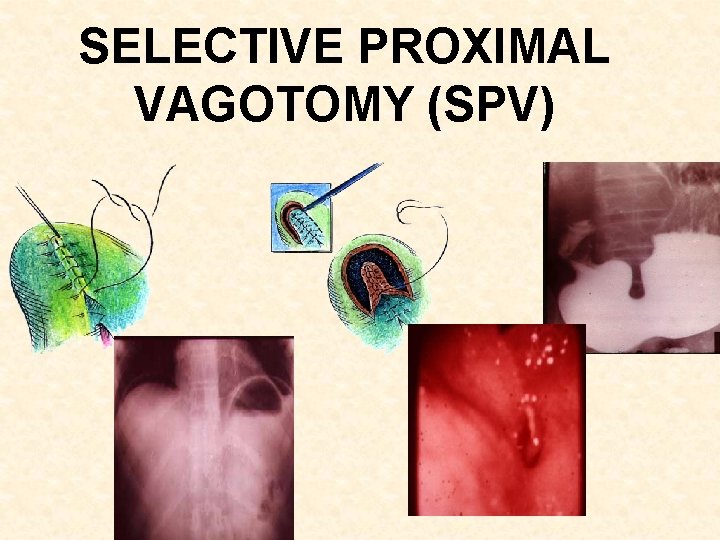 SELECTIVE PROXIMAL VAGOTOMY (SPV) 