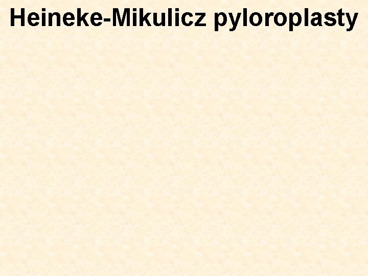 Heineke-Mikulicz pyloroplasty 