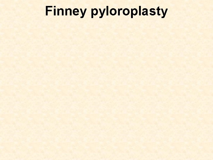 Finney pyloroplasty 