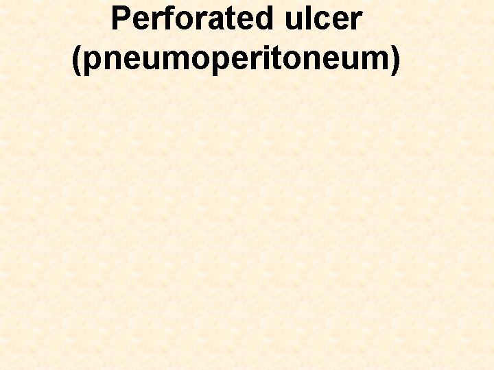 Perforated ulcer (pneumoperitoneum) 