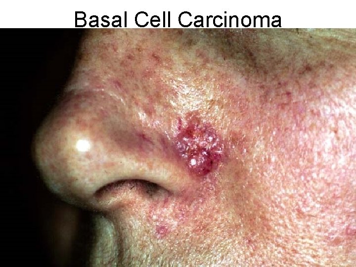 Basal Cell Carcinoma 